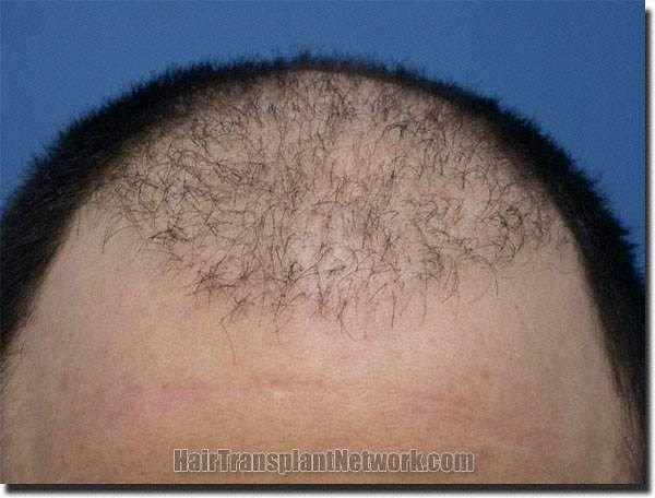 Hair restoration procedure results