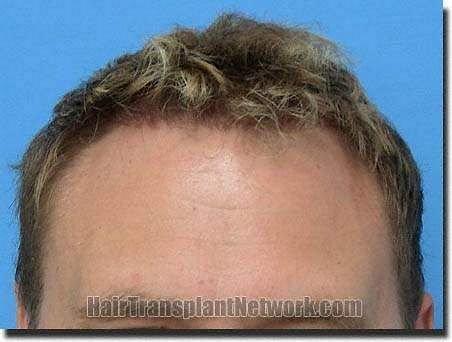 Hair restoration procedure results