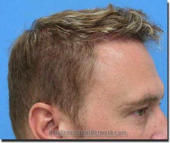 Hair restoration procedure results