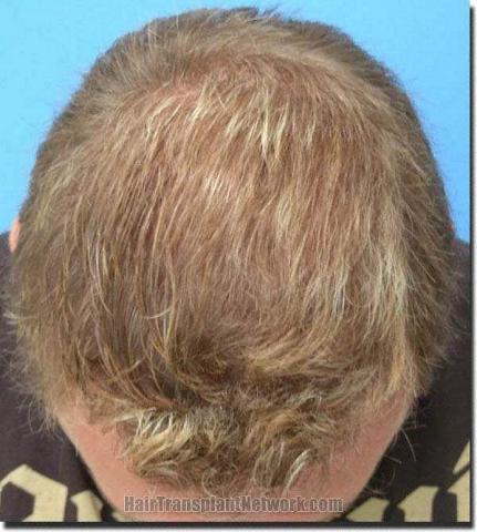 Hair restoration procedure results