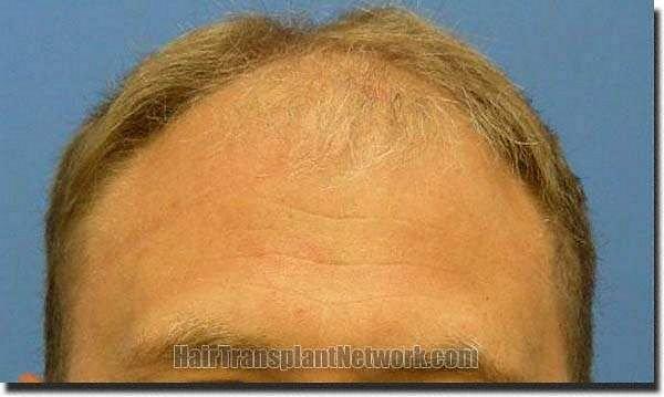 Hair restoration procedure results