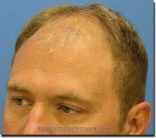 Hair restoration procedure results