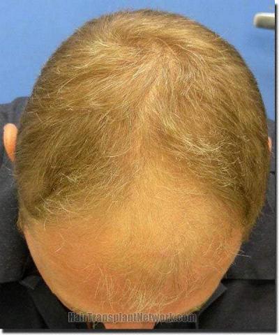 Hair restoration procedure results