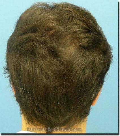 Hair restoration procedure results