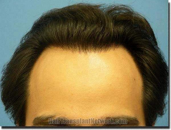 Hair restoration procedure results