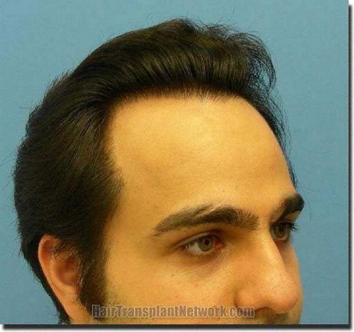 Hair restoration procedure results