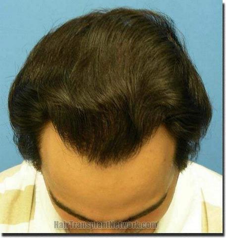 Hair restoration procedure results