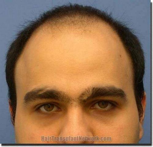 Hair restoration procedure results