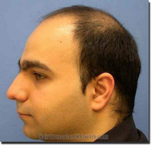 Hair restoration procedure results