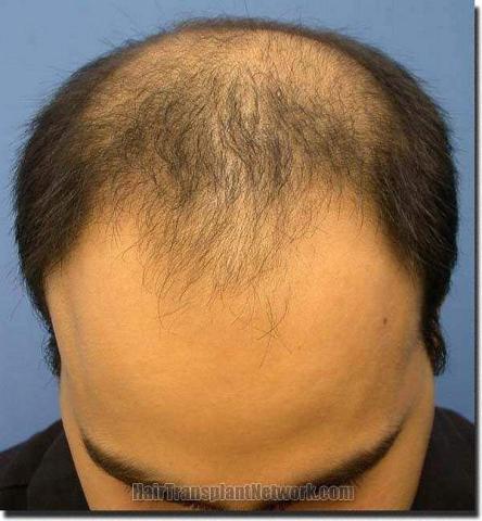 Hair restoration procedure results