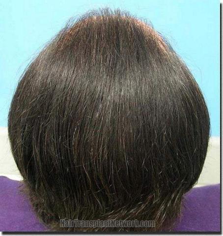 Hair restoration procedure results