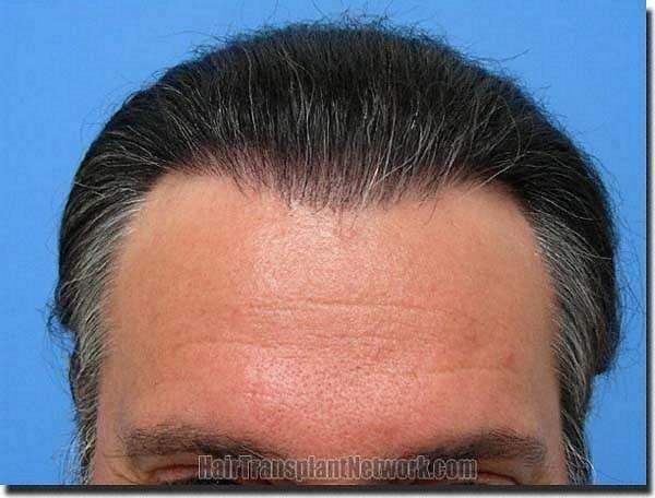 Hair restoration procedure results