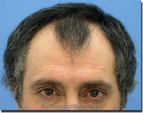 Hair restoration procedure results