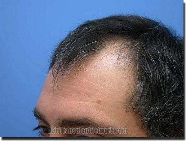 Hair restoration procedure results