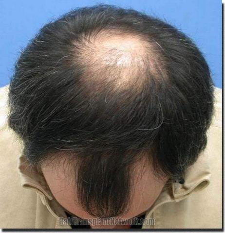 Hair restoration procedure results