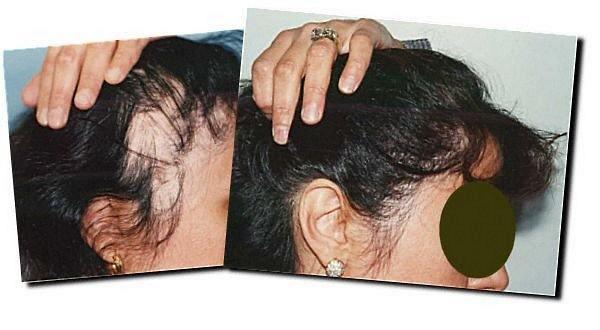 Hair restoration procedure results