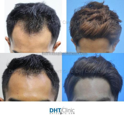 Before and after hair restoration procedure images