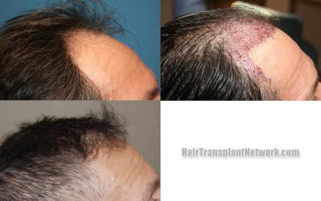 Hair transplantation procedure before and after results