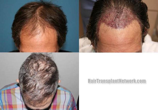 Before and after hair restoration procedure images