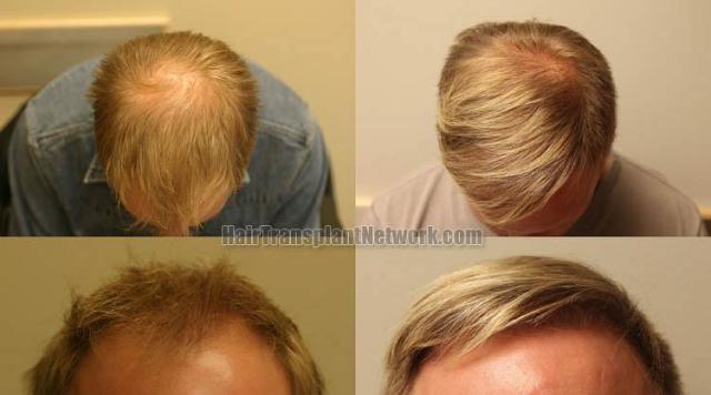 Hair transplantation surgery before and after images