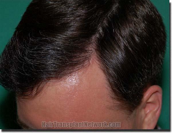 Hair restoration procedure results