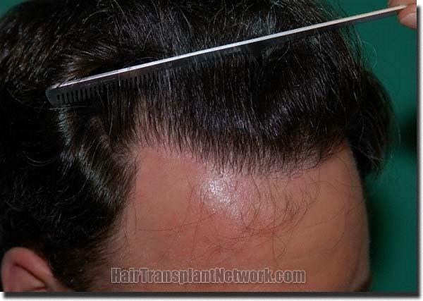 Hair restoration procedure results