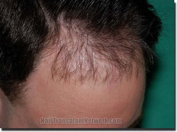 Hair restoration procedure results