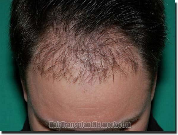 Hair restoration procedure results