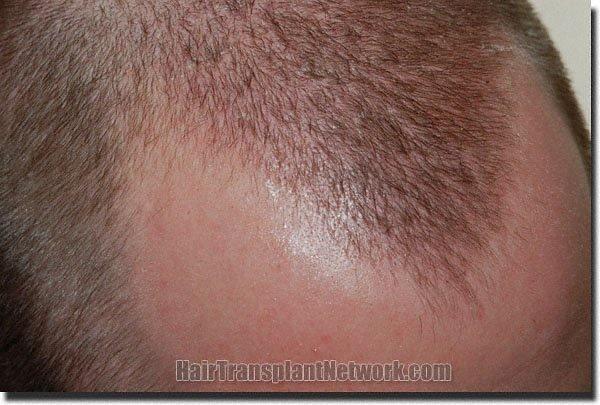 Hair restoration procedure results