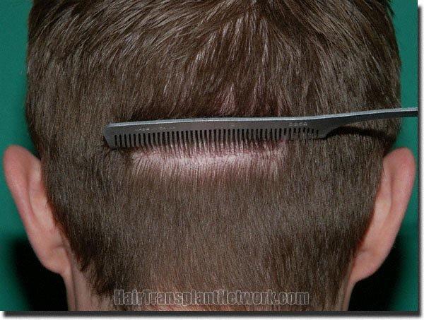 Hair restoration procedure results