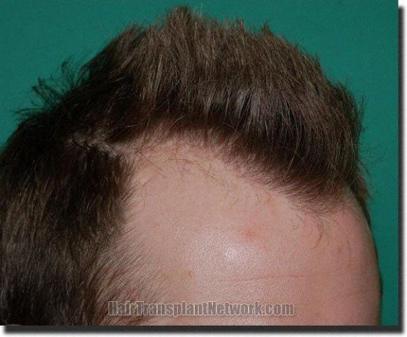 Hair restoration procedure results