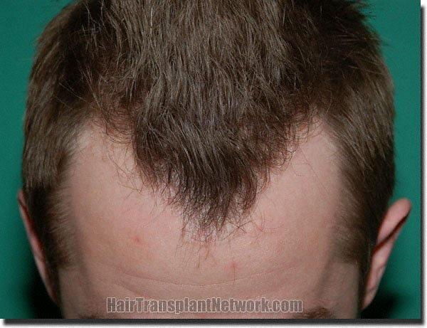 Hair restoration procedure results