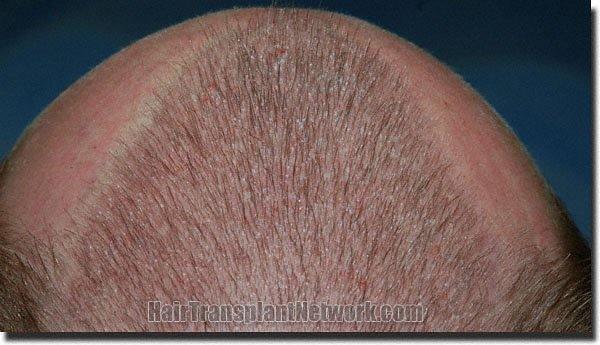 Hair restoration procedure results