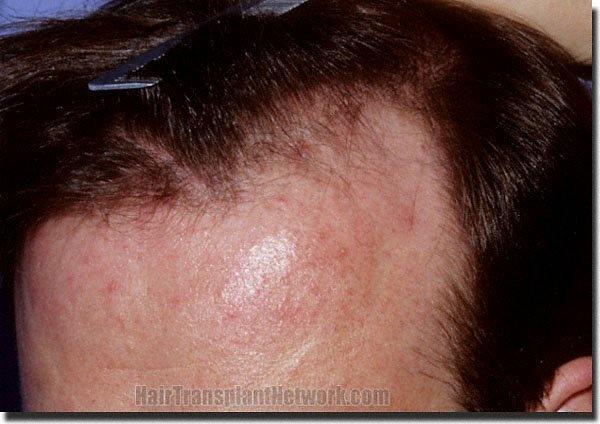 Hair restoration procedure results