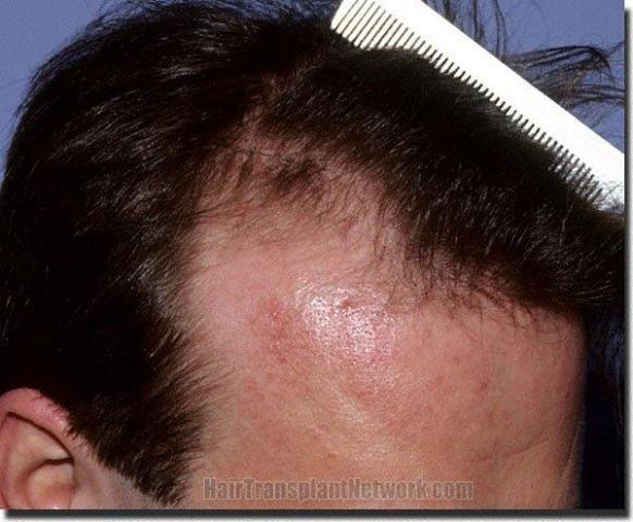 Hair restoration procedure results