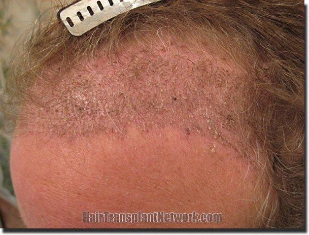 Hair restoration procedure results