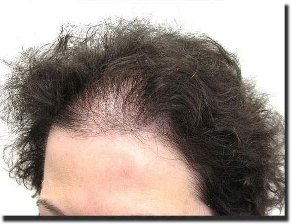 Hair restoration procedure results