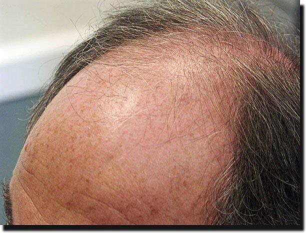 Hair restoration procedure results