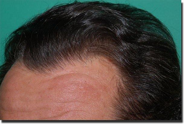 Hair restoration procedure results