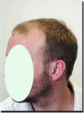 Hair restoration procedure results