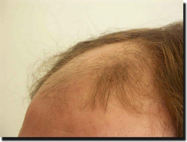 Hair restoration procedure results