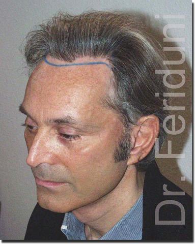 Hair restoration procedure results