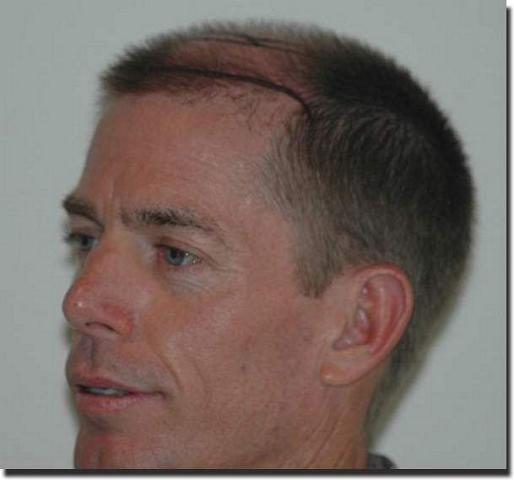 Hair restoration procedure results