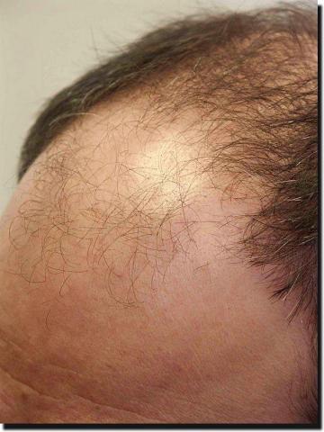 Hair restoration procedure results