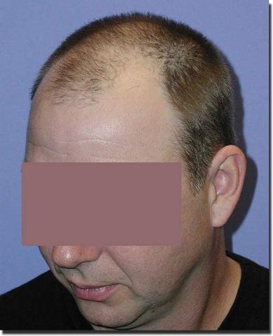 Hair restoration procedure results