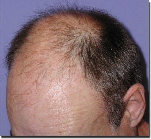 Hair restoration procedure results