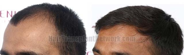 Left view before and after hair transplant surgery