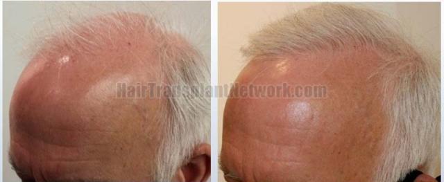 Left view before and after hair transplant surgery