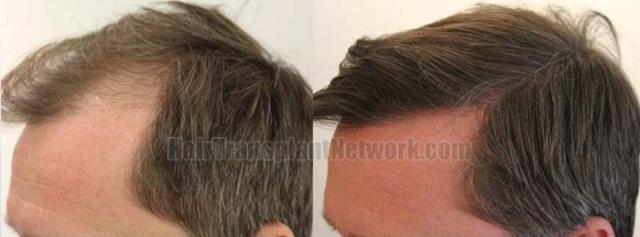 Left view before and after hair transplant surgery