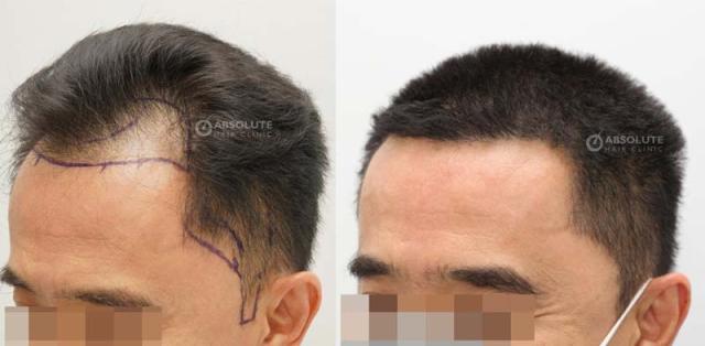 Left view before and after hair transplant surgery